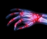 Machine learning identifies key genes linking rheumatoid arthritis and osteoporosis